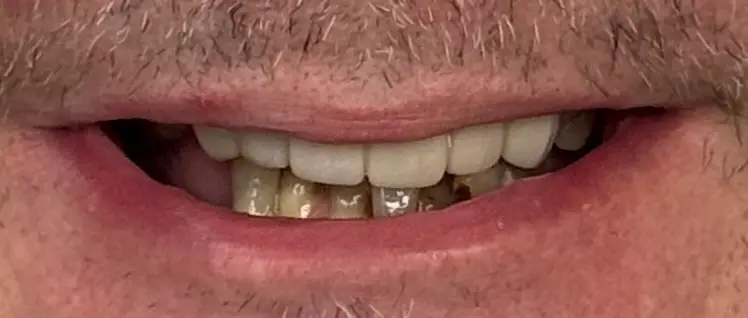 Alex before implant treatment with Dr. Constantine