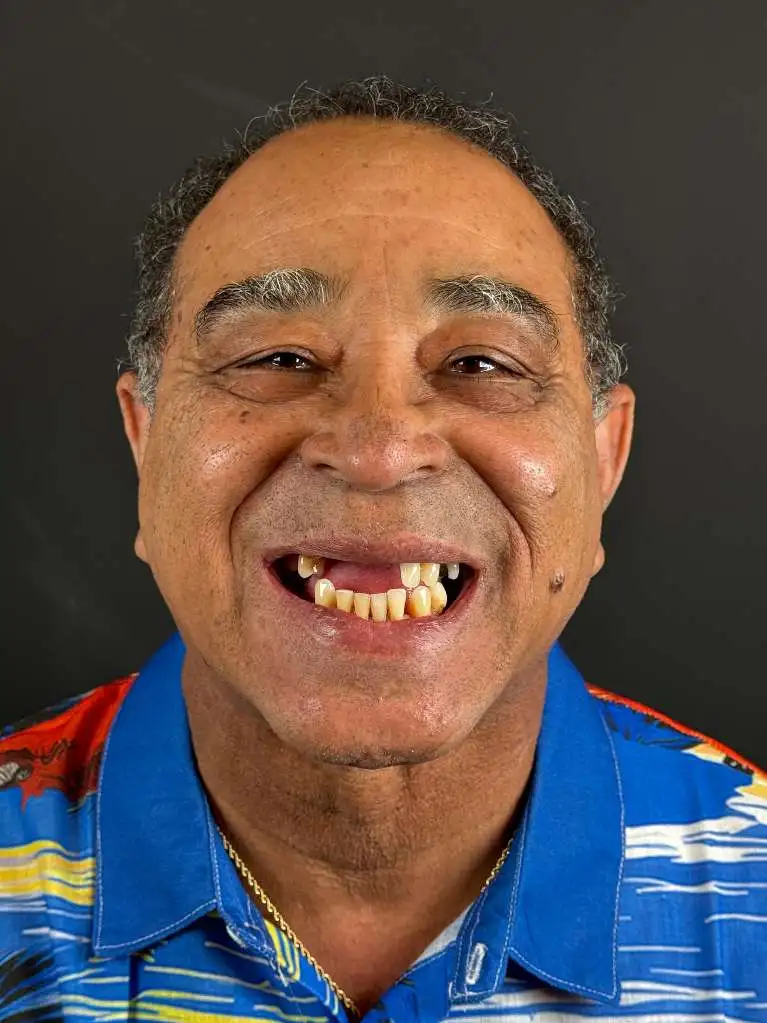 Patient smiling with several missing upper teeth before treatment