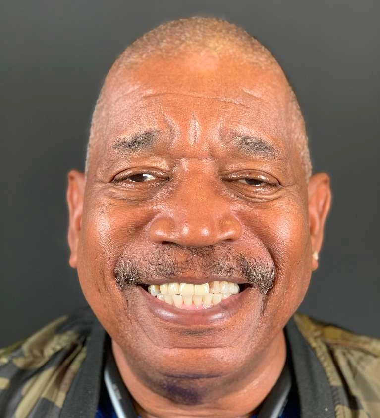 Patient smiling with failing upper teeth before All-on-X treatment