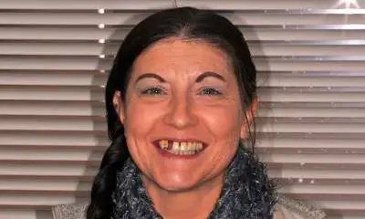 Patient smiling with worn and missing upper teeth before All-on-X implants