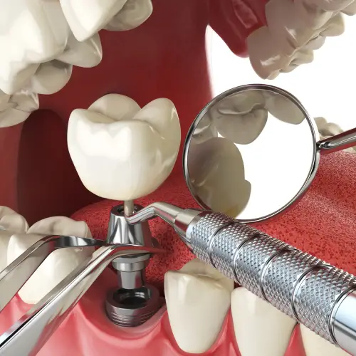 Illustration of a dental implant crown being placed with dental instruments