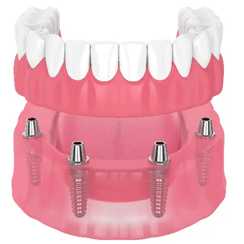 Illustration of a full denture secured on four dental implants