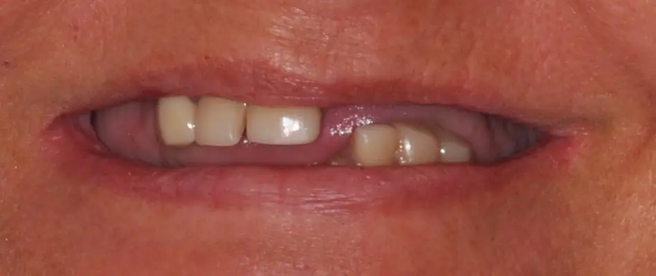 Joanne before implant treatment with Dr. Constantine