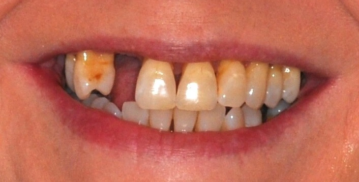 Paula before Upper All-on-X implant treatment with Dr. Constantine