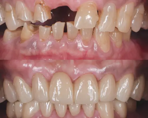 Before and after photos of damaged and missing front teeth restored with crowns and bridges