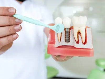 Illustration of a dental implant replacing a missing tooth