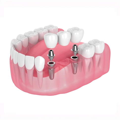 Illustration of a fixed dental bridge supported by two implants