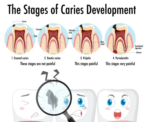Chart showing the stages of tooth decay from enamel caries to periodontitis