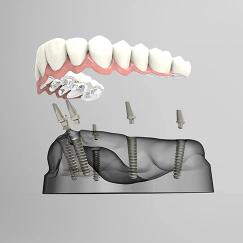 Illustration of a full-arch denture on four dental implants