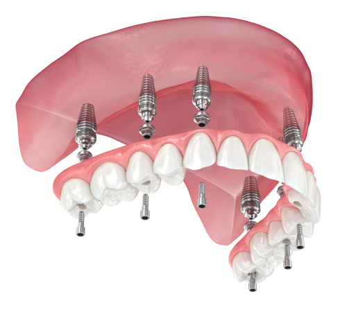 Illustration of a full-arch restoration on six dental implants