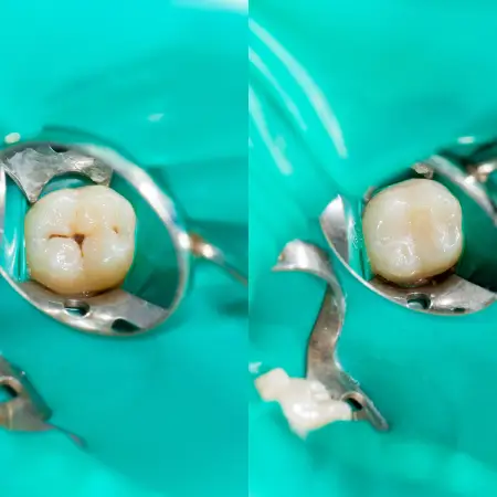 Close-up of sealants protecting molar grooves