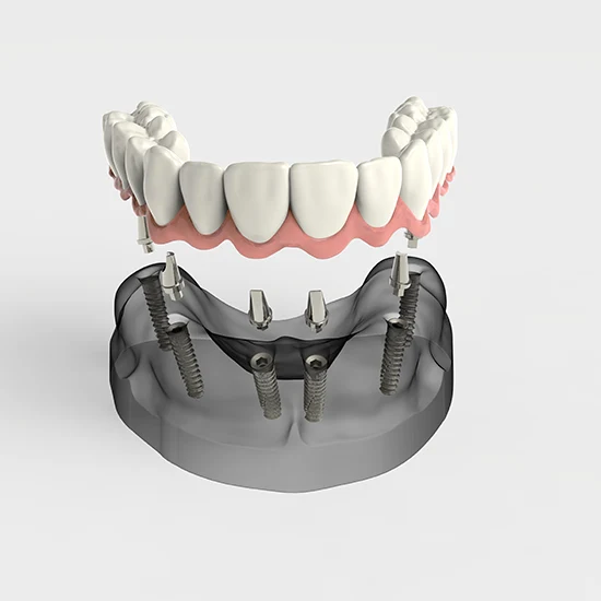 Illustration of full-mouth dental implants