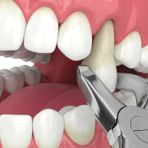 Illustration of dental forceps removing a misaligned upper tooth