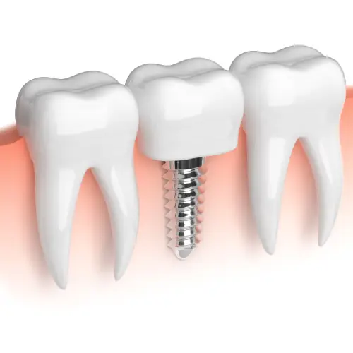 Illustration of a single dental implant between two natural teeth